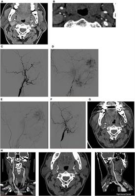 Carotid Endarterectomy for the Treatment of Carotid Near-Occlusion With Recurrent Symptoms